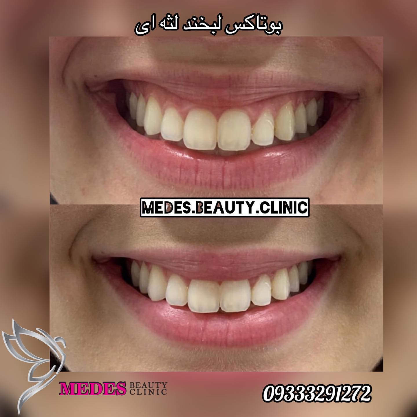 گالری تزریق بوتاکس